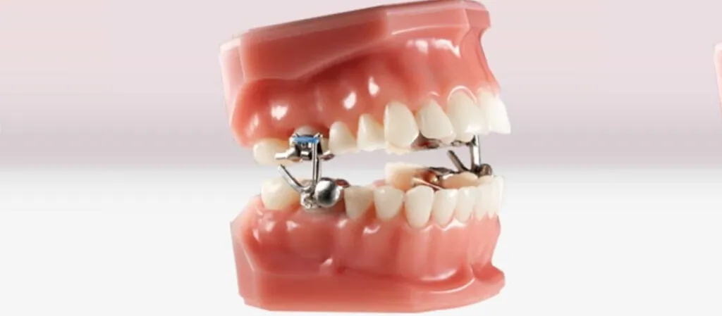Children's orthodontics in Riga, jaw expansion