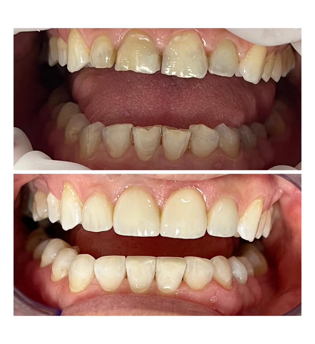 Dental Veneers, Riga