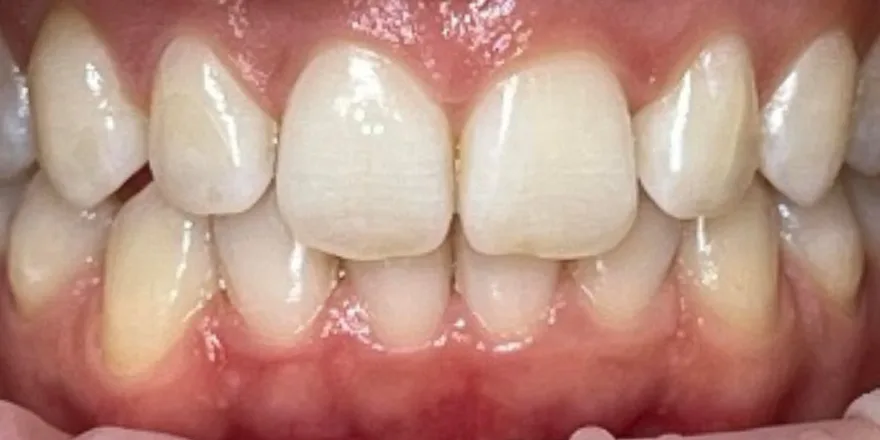 Ортодонтия: Invisalign прозрачные капы верхней и нижней челюсти. Срок 1 год. — после, случай 1, стоматология We Care в Риге