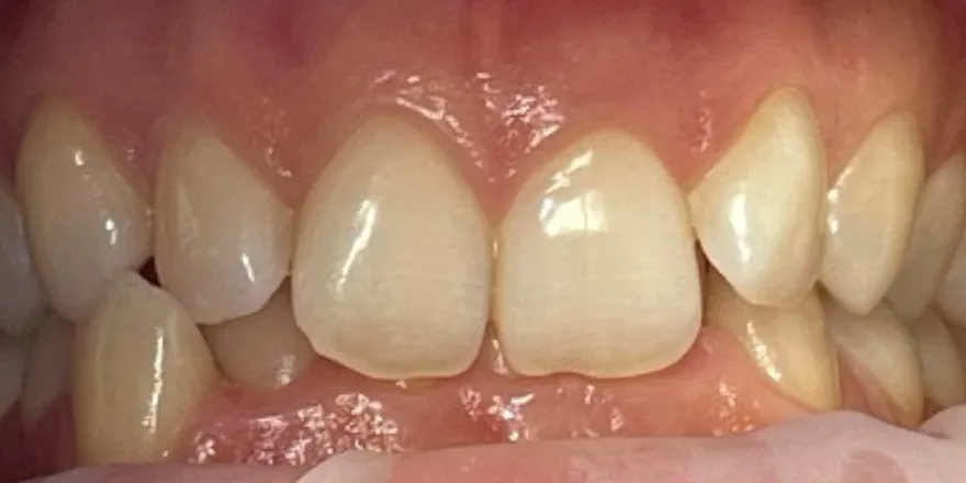 Ортодонтия: Invisalign прозрачные капы верхней и нижней челюсти. Срок 1 год. — до, случай 1, стоматология We Care в Риге