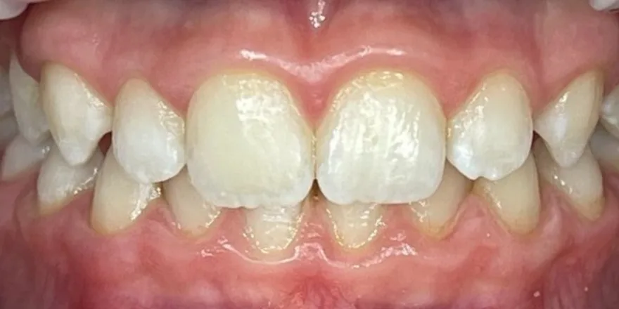 Ортодонтия: Invisalign First1 этап прозрачные капы верхней и нижней челюсти. Срок 18 месяцев. Мальчик, 8 лет. — после, случай 2, стоматология We Care в Риге