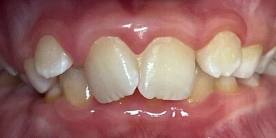 Ортодонтия: Invisalign First1 этап прозрачные капы верхней и нижней челюсти. Срок 18 месяцев. Мальчик, 8 лет. — до, случай 2, стоматология We Care в Риге