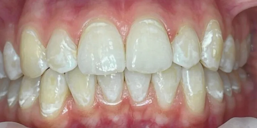 Ортодонтия: Invisalign Lite прозрачные капы верхней и нижней челюсти. Срок 13 месяцев. Девочка, 15 лет. — после, случай 3, стоматология We Care в Риге