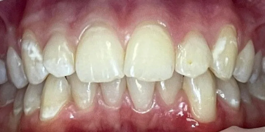 Ортодонтия: Invisalign Lite прозрачные капы верхней и нижней челюсти. Срок 13 месяцев. Девочка, 15 лет. — до, случай 3, стоматология We Care в Риге