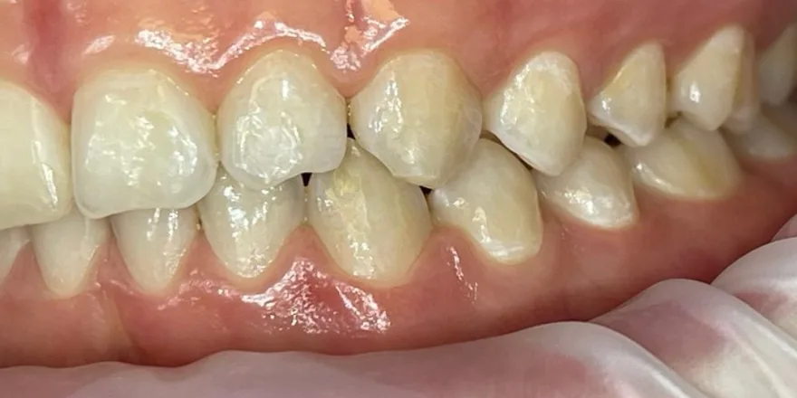 Ортодонтия: Invisalign First 1 этап прозрачные капы верхней и нижней челюсти. Срок 8 месяцев. Мальчик, 12 лет. — после, случай 4, стоматология We Care в Риге