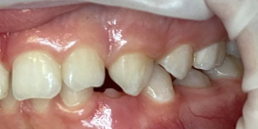 Ортодонтия: Invisalign First 1 этап прозрачные капы верхней и нижней челюсти. Срок 8 месяцев. Мальчик, 12 лет. — до, случай 4, стоматология We Care в Риге