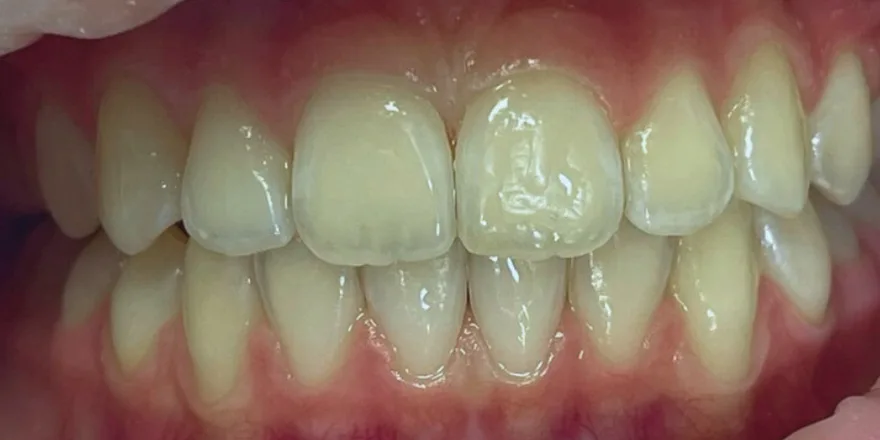 Ортодонтия: Invisalign First 1 этап прозрачные капы верхней и нижней челюсти. Срок 14 месяцев. Девочка, 11 лет. — после, случай 5, стоматология We Care в Риге