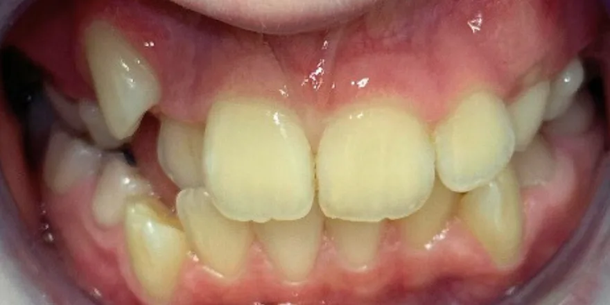 Ортодонтия: Invisalign First 1 этап прозрачные капы верхней и нижней челюсти. Срок 14 месяцев. Девочка, 11 лет. — до, случай 5, стоматология We Care в Риге