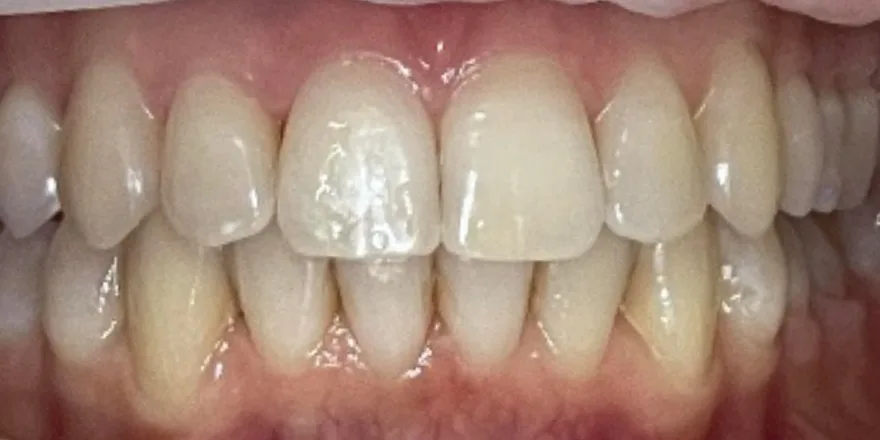 Ортодонтия: Invisalign прозрачные капы верхней и нижней челюсти. Срок 10 месяцев. — после, случай 6, стоматология We Care в Риге