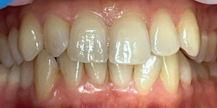 Ортодонтия: Invisalign прозрачные капы верхней и нижней челюсти. Срок 10 месяцев. — до, случай 6, стоматология We Care в Риге