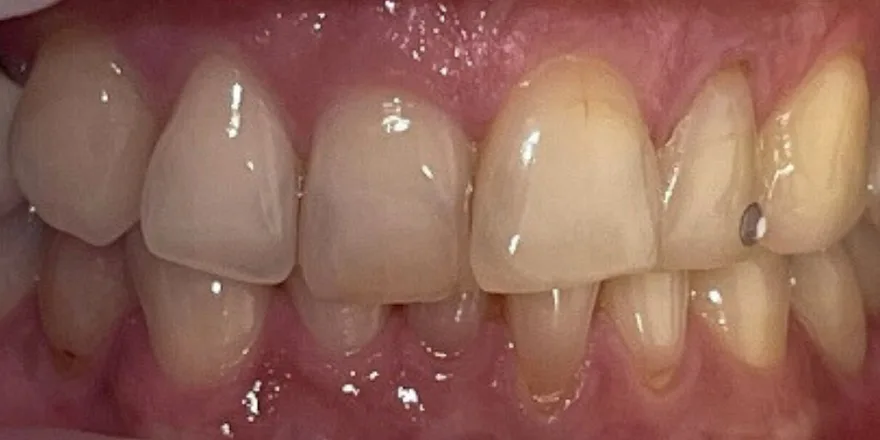 Ортодонтия: Invisalign прозрачные капы верхней и нижней челюсти. Эстетическая реставрация. Виниры d14-d24. Срок 24 месяцев. — до, случай 7, стоматология We Care в Риге